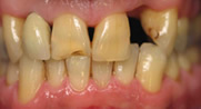 Before Cosmetic Dentistry